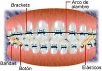 Conoce los elementos usados en ortodoncia